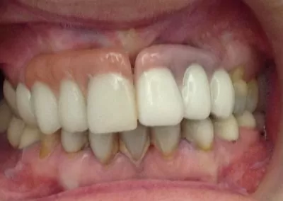 antes-despues-clinica-dental-sevilla-57