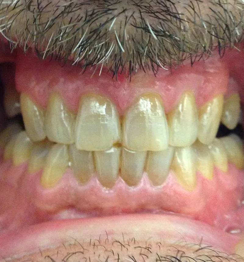 dientes antes y después del blanqueamiento
