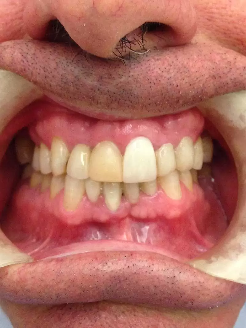 Dientes antes y después de blanqueamiento, fotos de dientes antes y despues