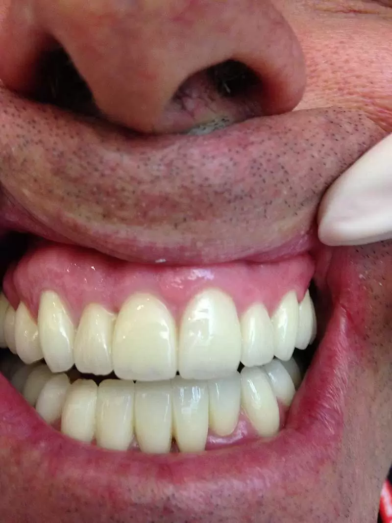 Dientes antes y después de blanqueamiento, fotos de dientes antes y despues