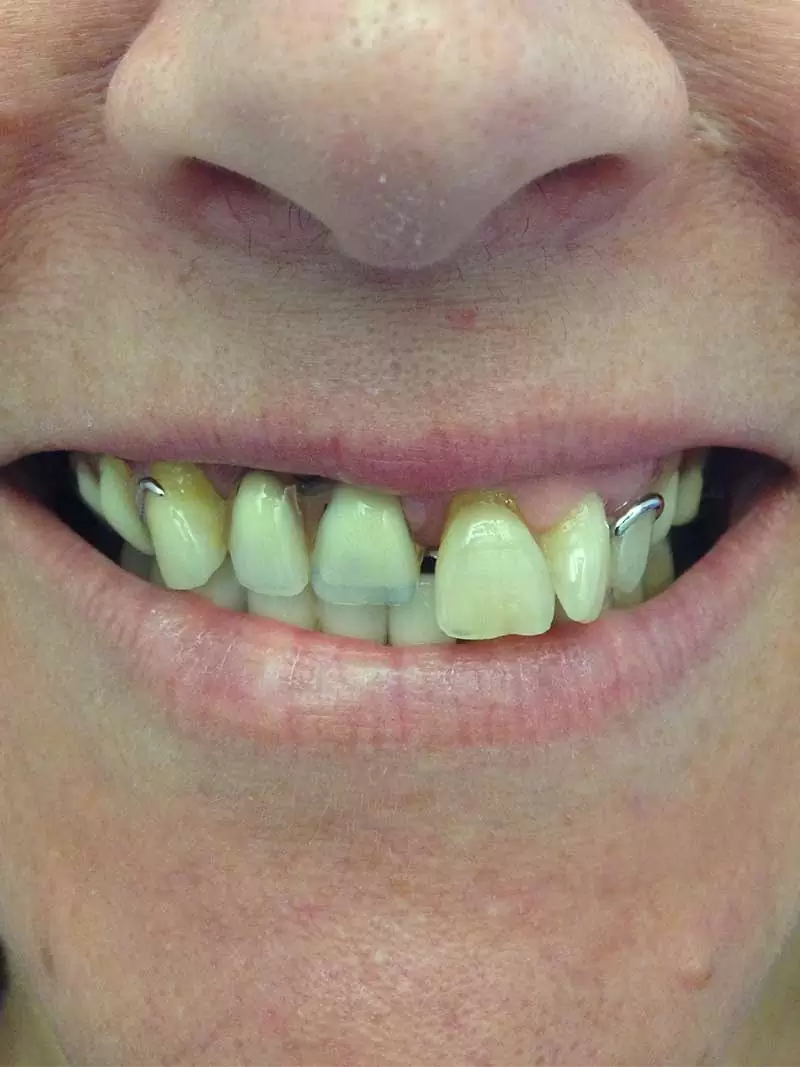 tratamientos dentales antes y después, dientes arreglados antes y después