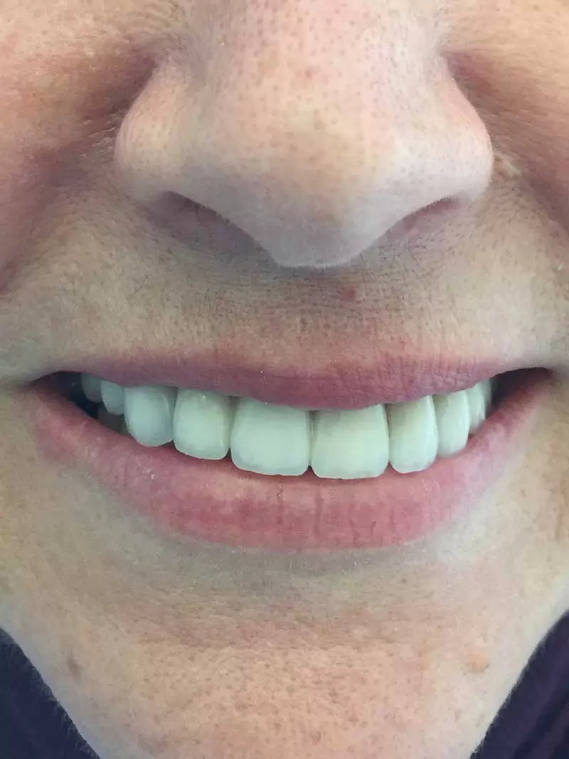 tratamientos dentales antes y después, dientes arreglados antes y después