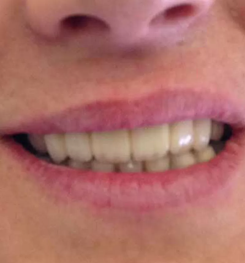 Prótesis dental antes y después, Prótesis dental híbrida, Prótesis dental fija, Prótesis dental removible