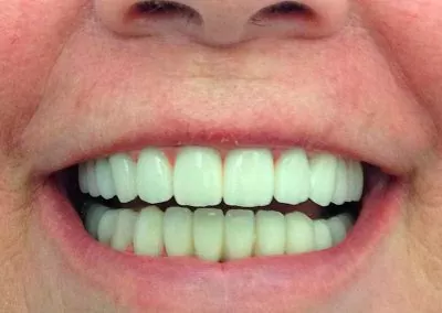 implantes-2-clinica-dental-sevilla