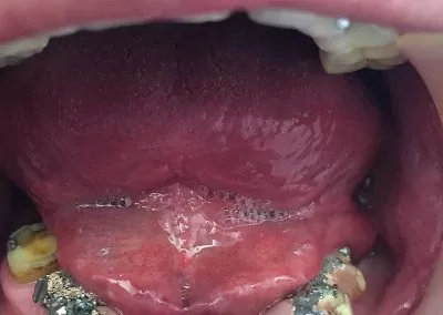 implantes-dentales-clinica-dental-sevilla-07
