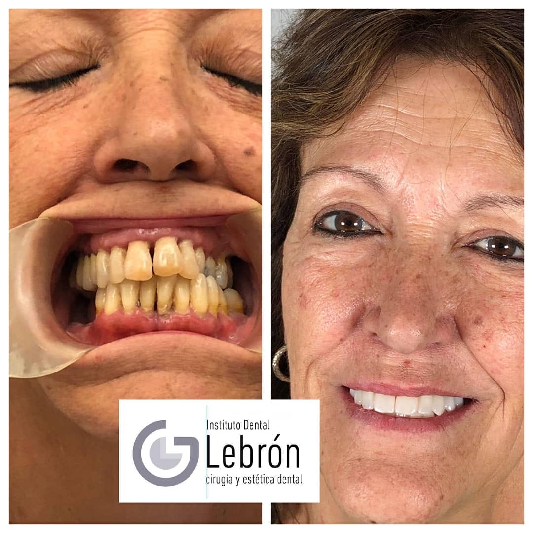 antes y después de implantes dentales guiados por ordenador , caso real de una paciente tras implantes