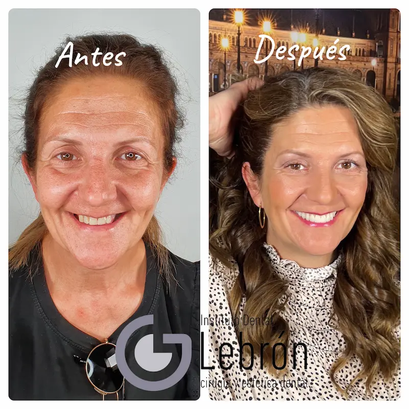 Antes y después de tratamiento de Estética dental en Sevilla  con cirugía Guiada